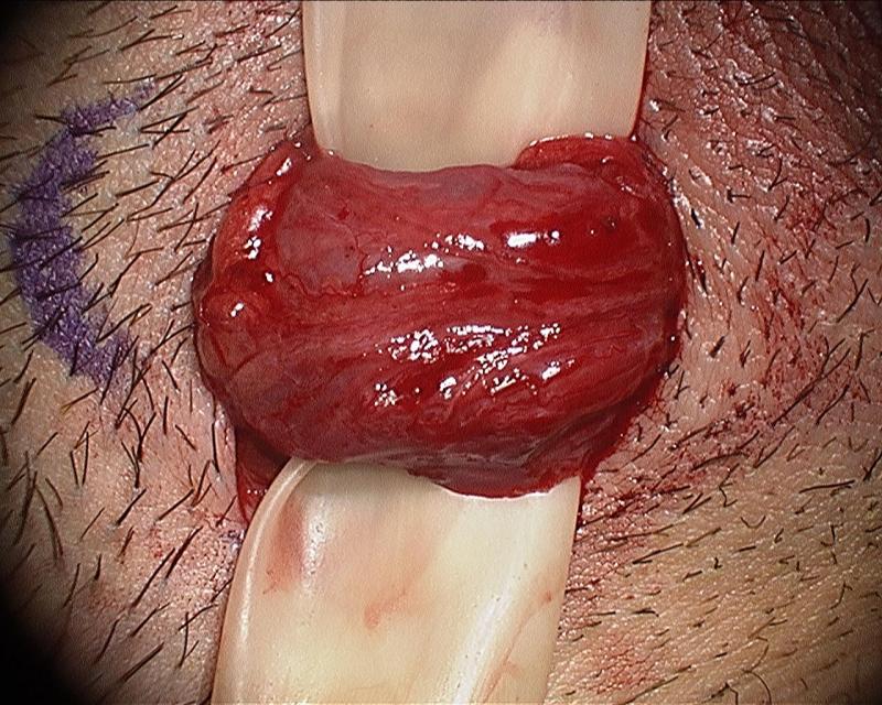 Microsurgical Denervation of the Spermatic Cord by Daniel Williams