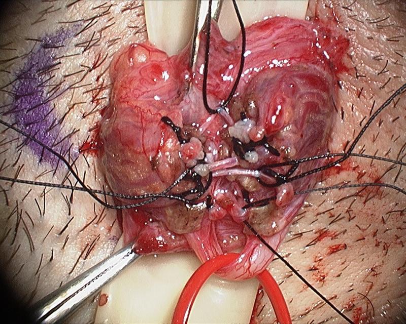 Microsurgical Denervation of the Spermatic Cord by Daniel Williams