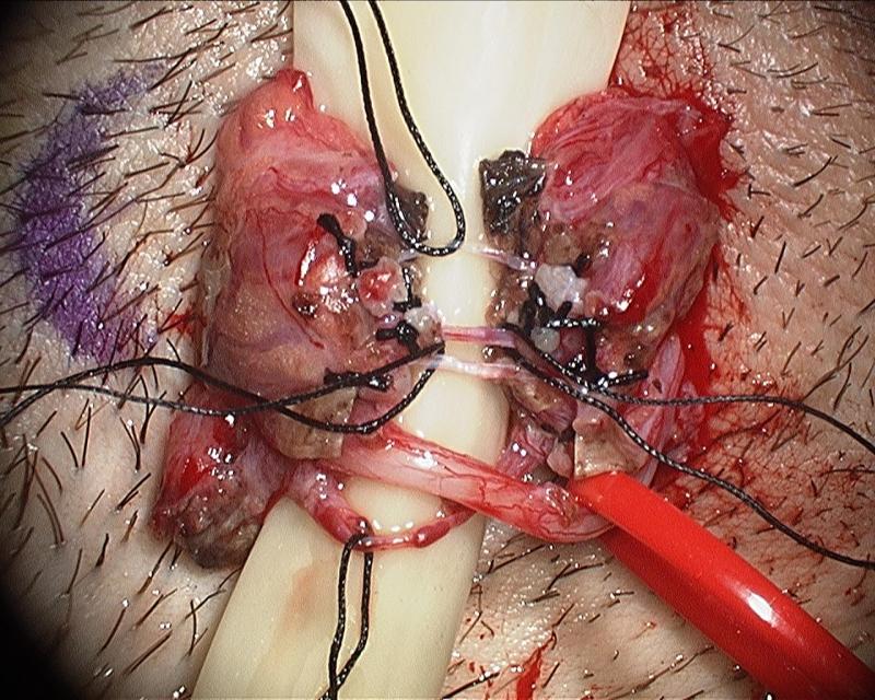 Microsurgical Denervation of the Spermatic Cord by Daniel Williams