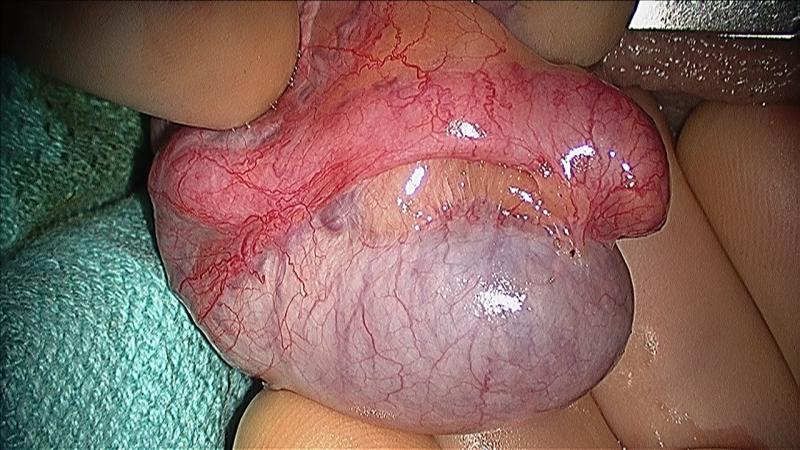 micro-TESE, male infertility, microsurgery, williams, urology, IVF, ICSI