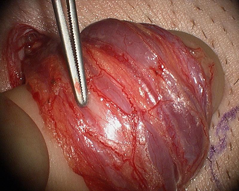 Microsurgical Varicocelectomy by Dr. Daniel Williams