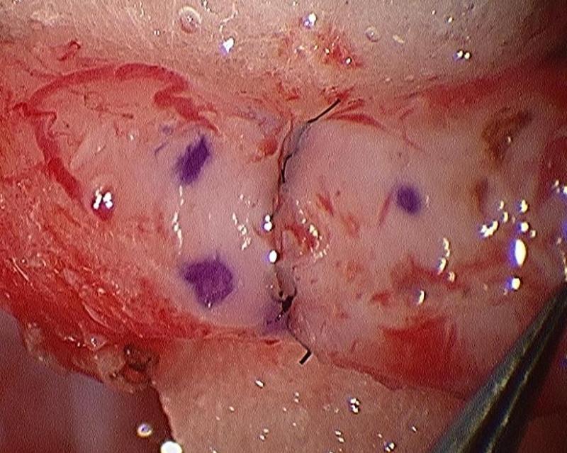 Daniel H. Williams Microsurgical Vasectomy Reversal Vasovasostomy
