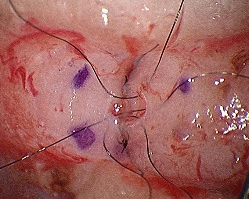Daniel H. Williams Microsurgical Vasectomy Reversal Vasovasostomy