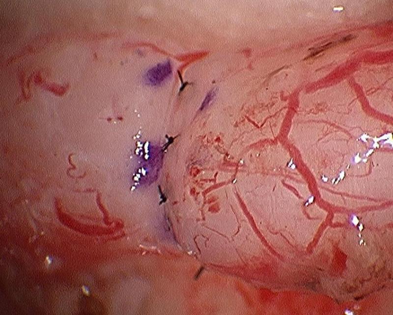 Daniel H. Williams Microsurgical Vasectomy Reversal Vasovasostomy