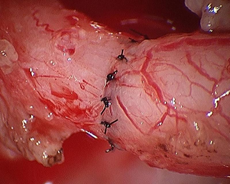 Daniel H. Williams Microsurgical Vasectomy Reversal Vasovasostomy