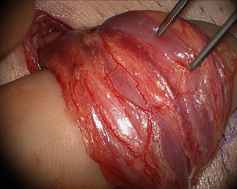 Microsurgical Varicocelectomy by Dr. Daniel Williams