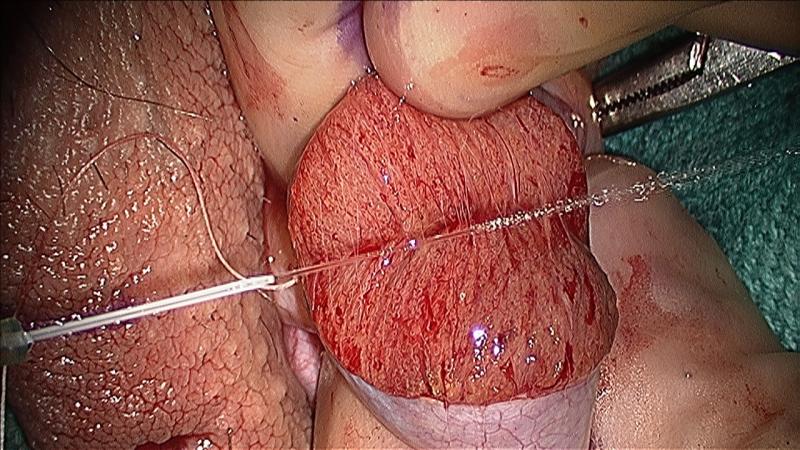 micro-TESE, male infertility, microsurgery, sperm retrieval, williams, urology