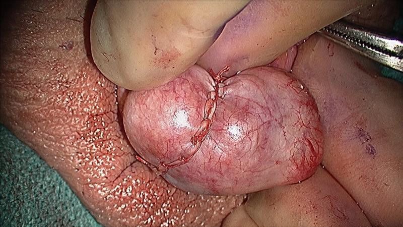 micro-TESE, male infertility, IVF, sperm retrieval, williams, urology, testicle