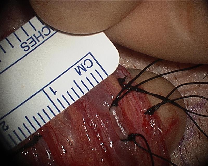 Microsurgical Varicocelectomy by Dr. Daniel Williams