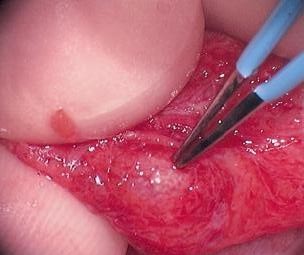 micro-TESE, sperm retrieval, williams, urology, microsurgery, male infertility