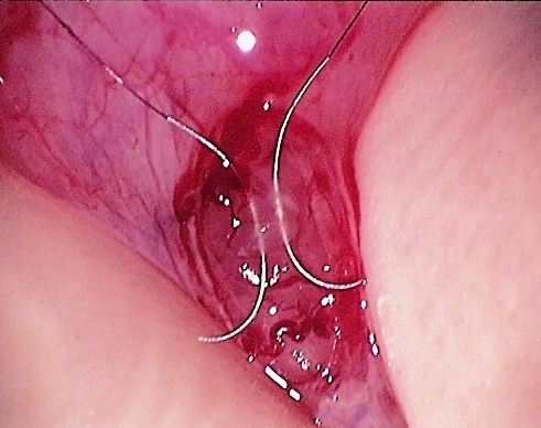 Daniel H. Williams Microsurgical Vasectomy Reversal Epididymovasostomy