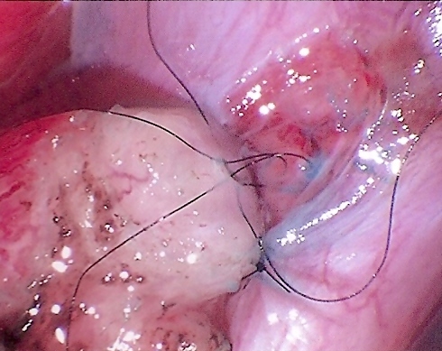 Daniel H. Williams Microsurgical Vasectomy Reversal Epididymovasostomy