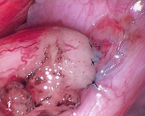 Daniel H. Williams Microsurgical Vasectomy Reversal Epididymovasostomy