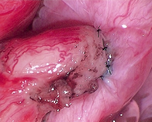 Daniel H. Williams Microsurgical Vasectomy Reversal Epididymovasostomy